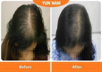 Yun-Nam-Hair-Care-Scalp-Treatment-Promo-350x247 - Beauty & Health Hair Care Johor Kedah Kelantan Kuala Lumpur Melaka Negeri Sembilan Online Store Pahang Penang Perak Perlis Promotions & Freebies Putrajaya Sabah Sarawak Selangor Terengganu 